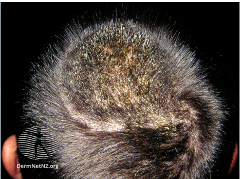 Tinea capitis (scalp ringworm) 