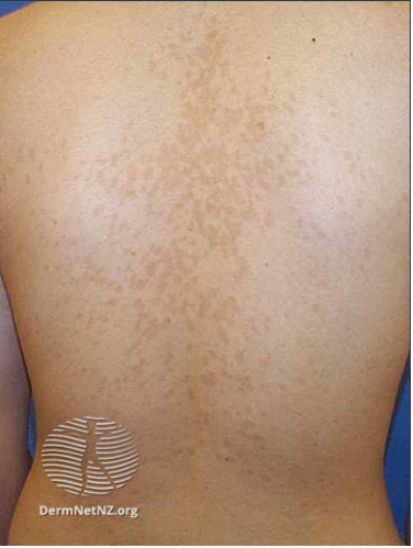 What is pityriasis versicolor? Causes, symptoms and treatment