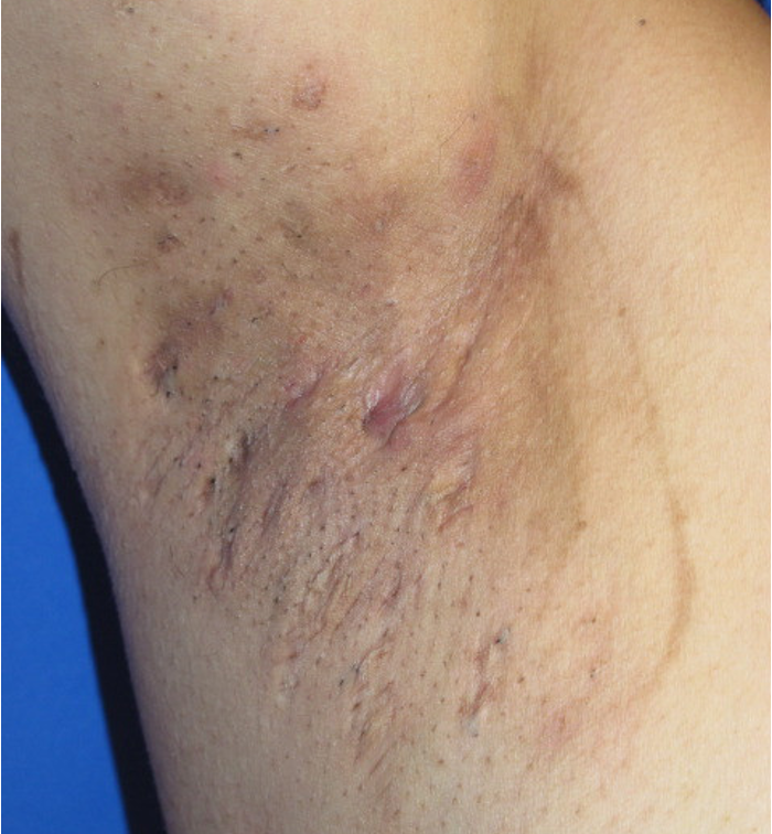 Dermesthetic - Hidradenitis Suppurativa (HS) also known as acne