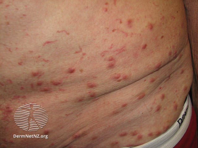 scabies rash on stomach